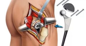 koksartroz kak i gde ego lechit 3d36371