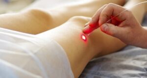 lazernoe lechenie varikoza chto nuzhno znat 29ffc89