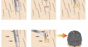 osnovnye metody peresadki volos dlja muzhchin 6f9bf01