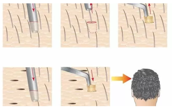 Основные методы пересадки волос для мужчин