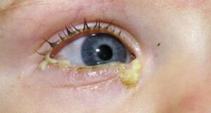 konjunktivit u mladencev prichiny i lechenie 0205695