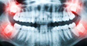 stomatologicheskaja procedura kjuretazh parodontalnogo karmana dfba3e9