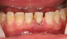 Как происходит снятие зубных отложений с помощью ультразвука