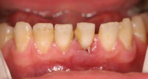 kak proishodit snjatie zubnyh otlozhenij s pomoshhju ultrazvuka 0fccea1