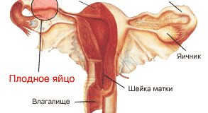 vnematochnaja beremennost 9216856