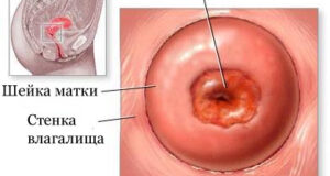 erozija shejki matki 78863ab