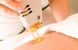 lazernaja epiljacija fcb33db